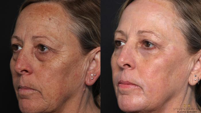 Before & After Blepharoplasty Case 636 Left Oblique View in Fort Worth & Arlington, Texas
