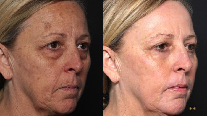 Before & After Blepharoplasty Case 636 Right Oblique View in Fort Worth & Arlington, Texas