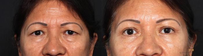 Before & After Blepharoplasty Case 639 Front View in Fort Worth & Arlington, Texas