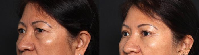 Before & After Blepharoplasty Case 639 Left Oblique View in Fort Worth & Arlington, Texas
