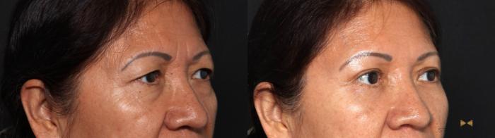 Before & After Blepharoplasty Case 639 Right Oblique View in Fort Worth & Arlington, Texas
