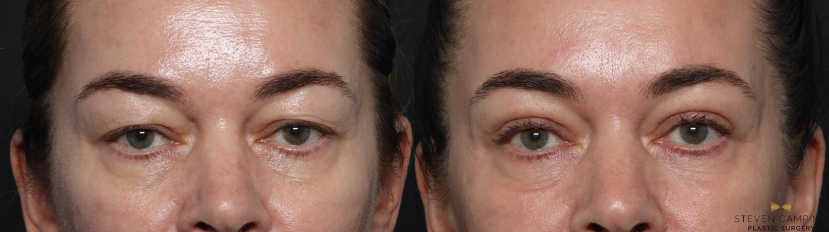 Before & After Blepharoplasty Case 642 Front View in Fort Worth, Texas