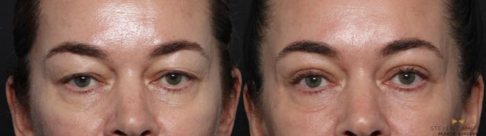 Before & After Blepharoplasty Case 642 Front View in Fort Worth & Arlington, Texas