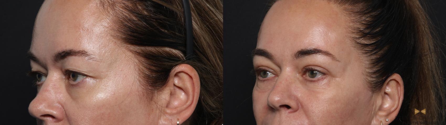 Before & After Blepharoplasty Case 642 Left Oblique View in Fort Worth & Arlington, Texas