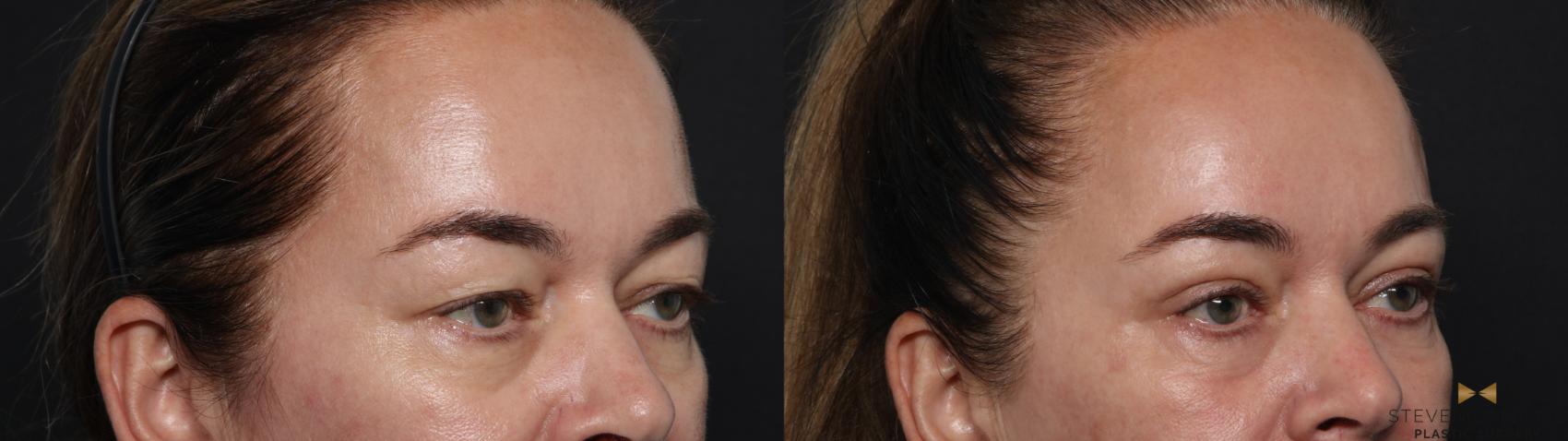 Before & After Blepharoplasty Case 642 Right Oblique View in Fort Worth & Arlington, Texas