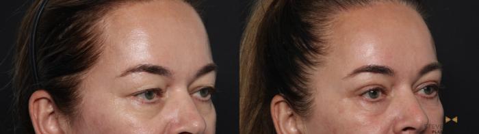 Before & After Blepharoplasty Case 642 Right Oblique View in Fort Worth & Arlington, Texas