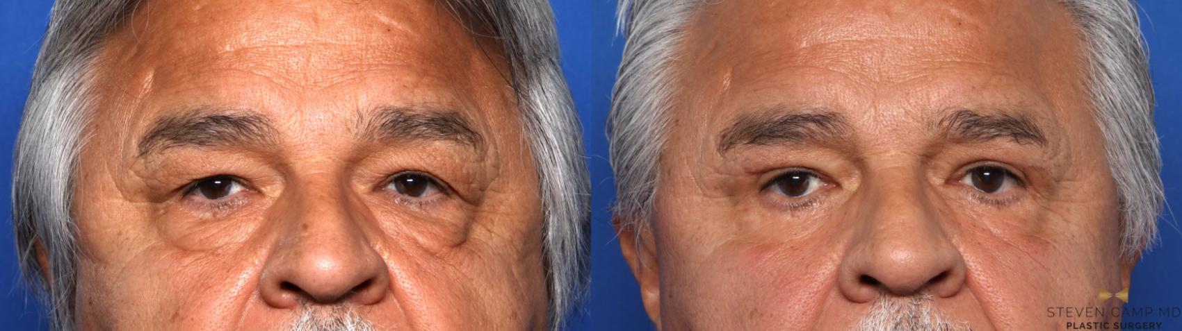 Before & After Blepharoplasty Case 661 Front View in Fort Worth & Arlington, Texas
