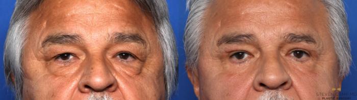 Before & After Blepharoplasty Case 661 Front View in Fort Worth & Arlington, Texas