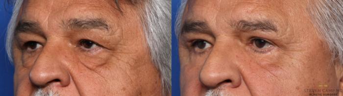 Before & After Blepharoplasty Case 661 Left Oblique View in Fort Worth & Arlington, Texas