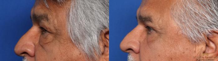 Before & After Blepharoplasty Case 661 Left Side View in Fort Worth & Arlington, Texas