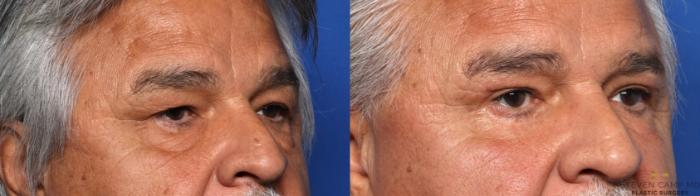 Before & After Blepharoplasty Case 661 Right Oblique View in Fort Worth & Arlington, Texas