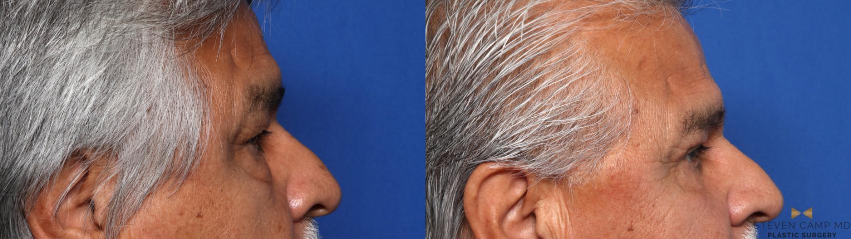 Before & After Blepharoplasty Case 661 Right Side View in Fort Worth & Arlington, Texas