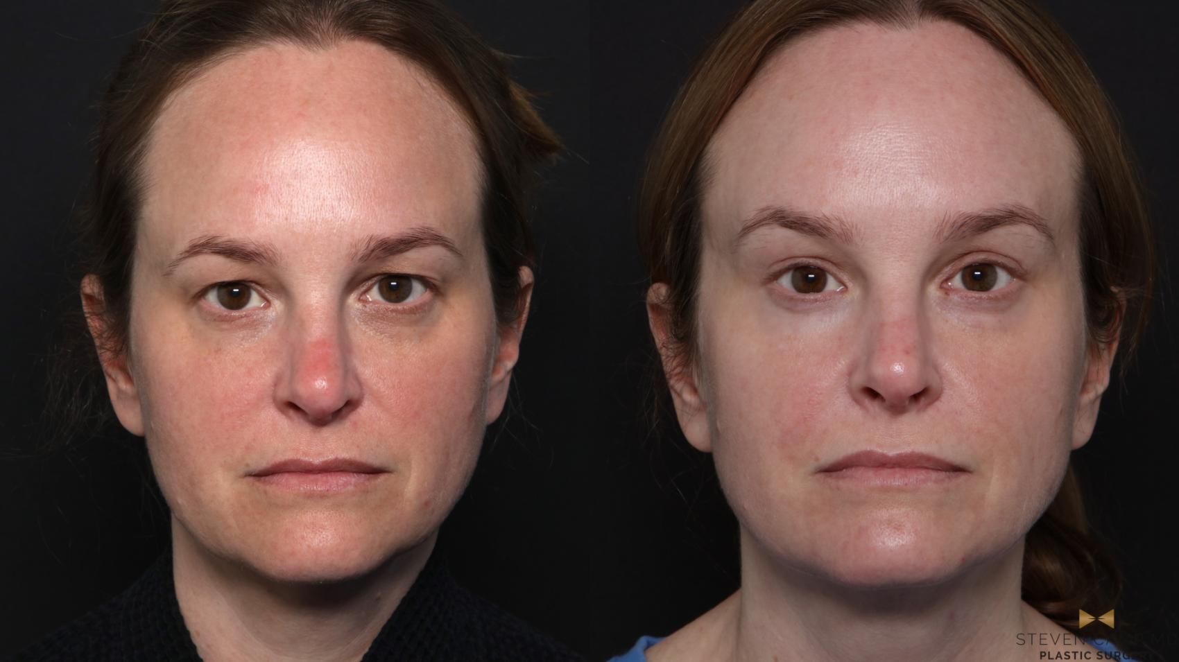 Before & After Blepharoplasty Case 671 Front View in Fort Worth & Arlington, Texas