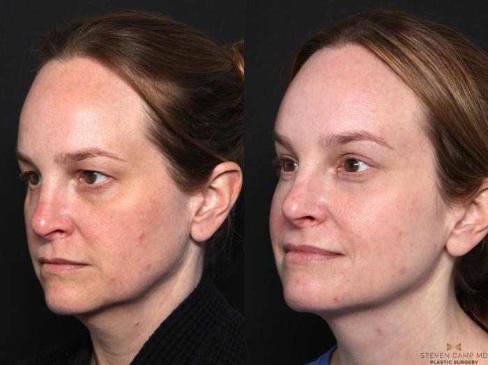 Before & After Blepharoplasty Case 671 Left Oblique View in Fort Worth & Arlington, Texas