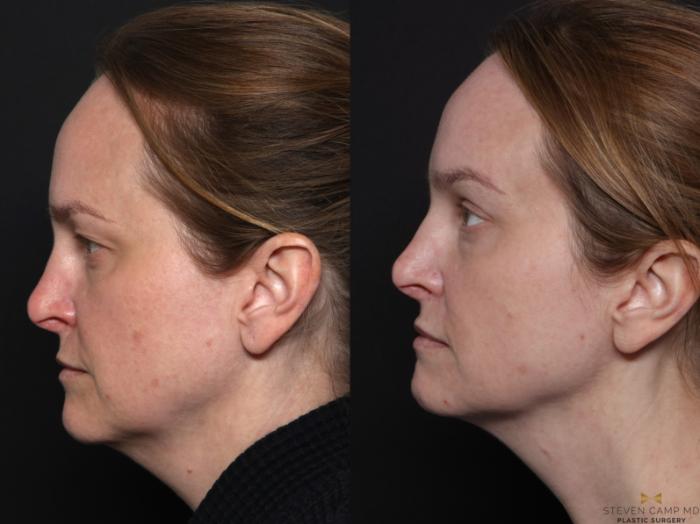 Before & After Blepharoplasty Case 671 Left Side View in Fort Worth & Arlington, Texas