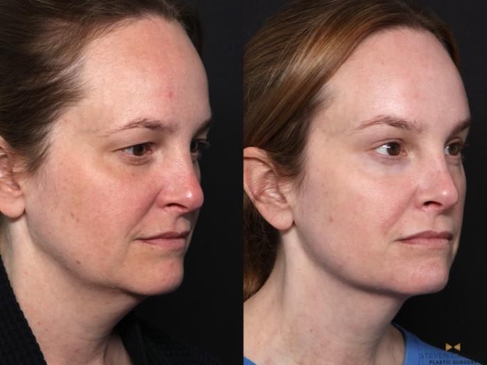 Before & After Blepharoplasty Case 671 Right Oblique View in Fort Worth & Arlington, Texas