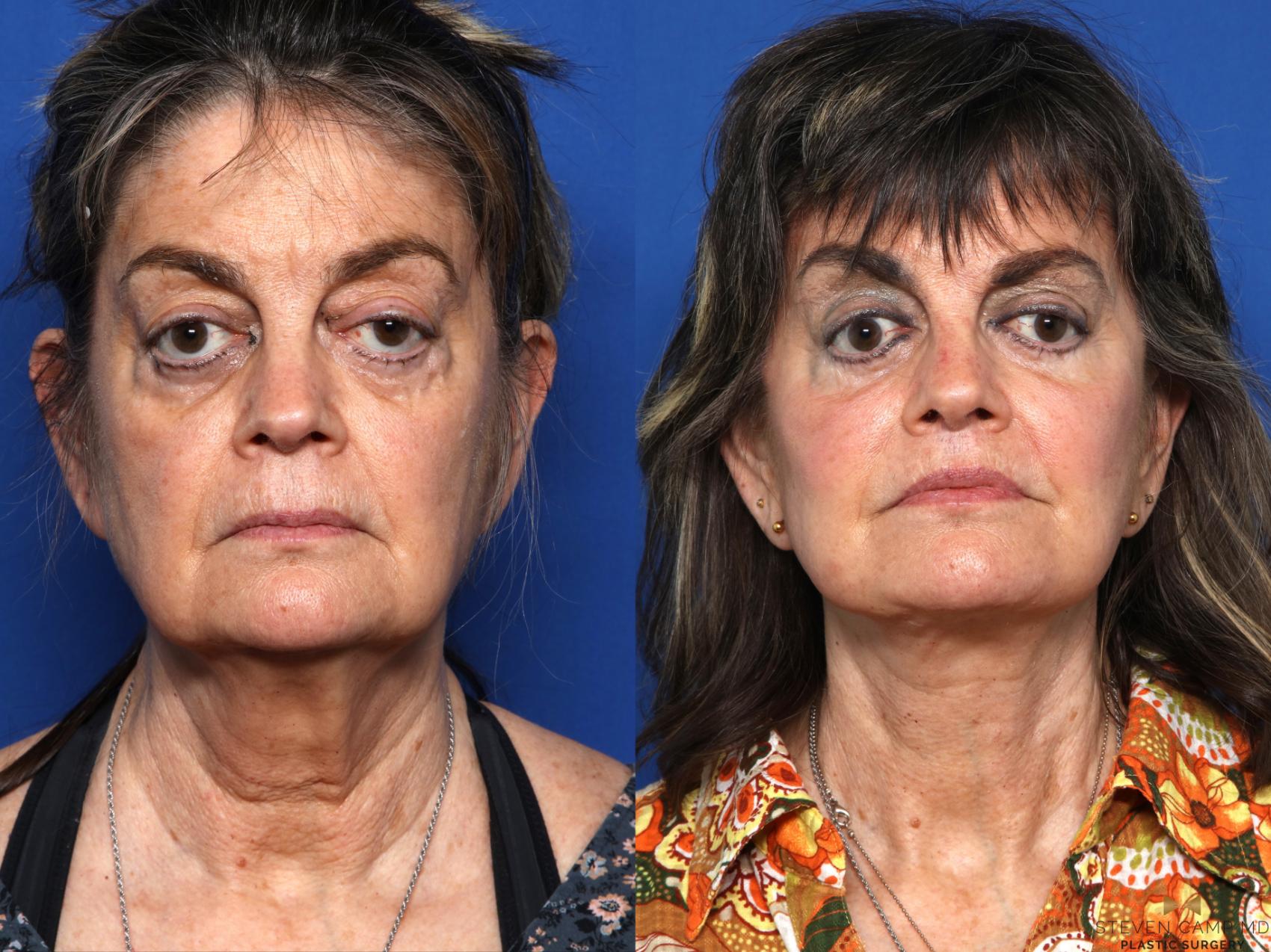 Before & After Blepharoplasty Case 674 Front View in Fort Worth & Arlington, Texas