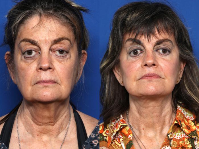 Before & After Blepharoplasty Case 674 Front View in Fort Worth & Arlington, Texas