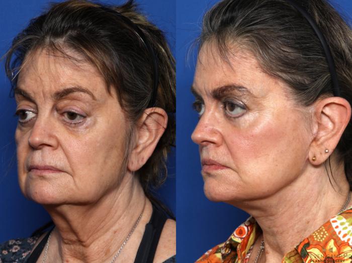 Before & After Blepharoplasty Case 674 Left Oblique View in Fort Worth & Arlington, Texas