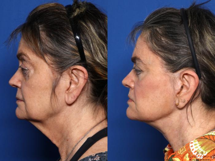 Before & After Blepharoplasty Case 674 Left Side View in Fort Worth & Arlington, Texas
