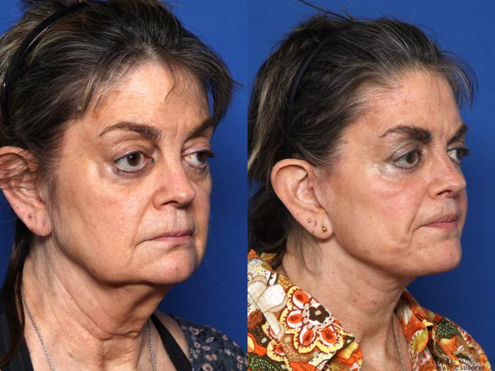 Before & After Blepharoplasty Case 674 Right Oblique View in Fort Worth & Arlington, Texas