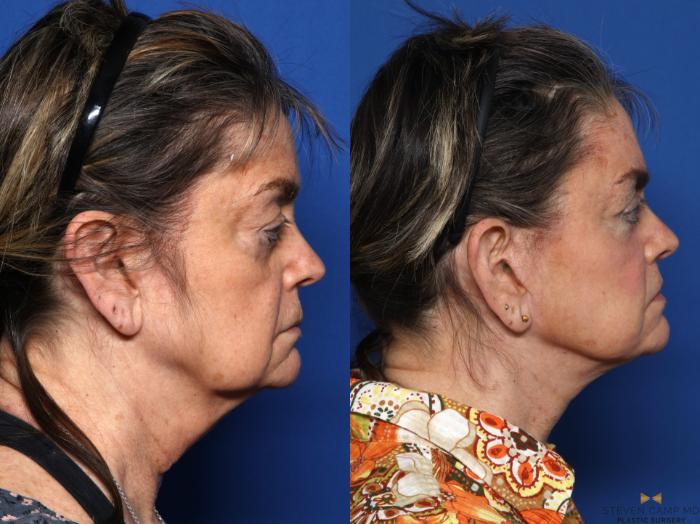 Before & After Blepharoplasty Case 674 Right Side View in Fort Worth & Arlington, Texas