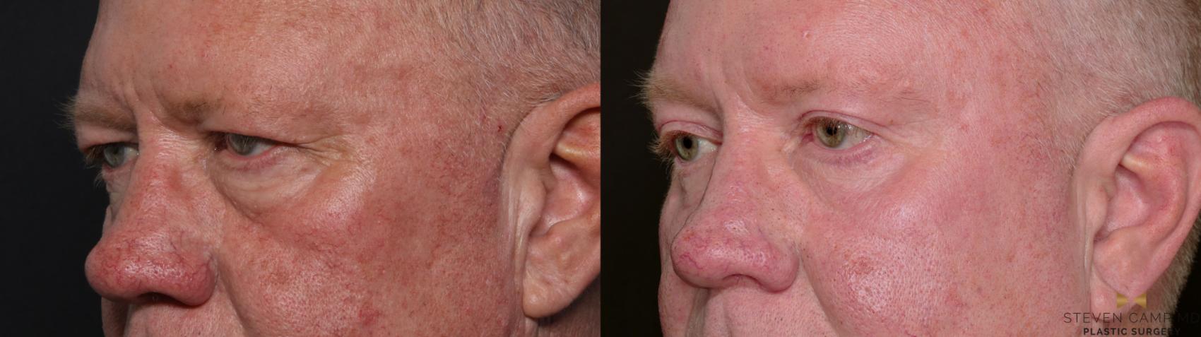 Before & After Brow Lift Case 703 Left Oblique View in Fort Worth & Arlington, Texas