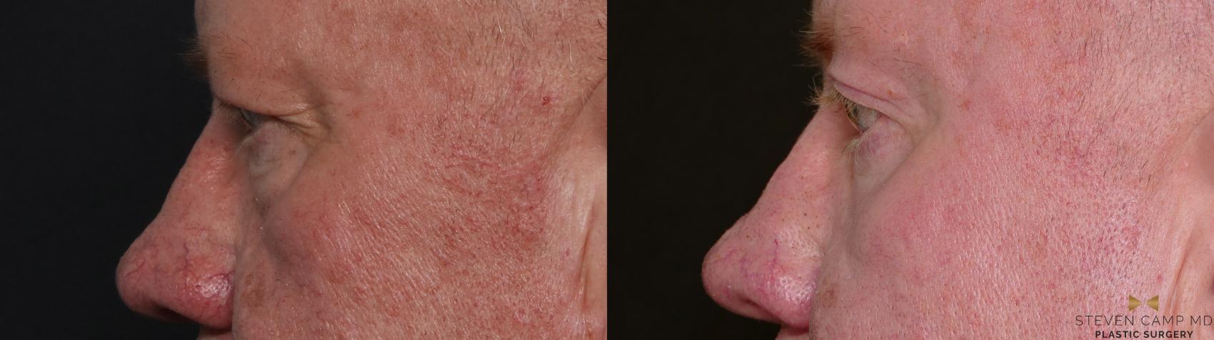Before & After Brow Lift Case 703 Left Side View in Fort Worth & Arlington, Texas