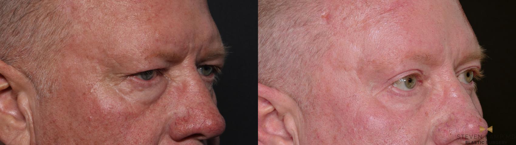 Before & After Brow Lift Case 703 Right Oblique View in Fort Worth & Arlington, Texas