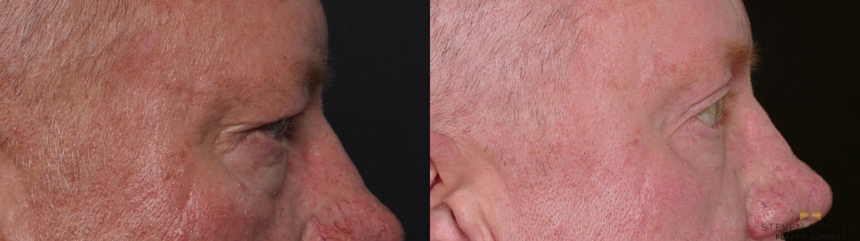 Before & After Brow Lift Case 703 Right Side View in Fort Worth & Arlington, Texas