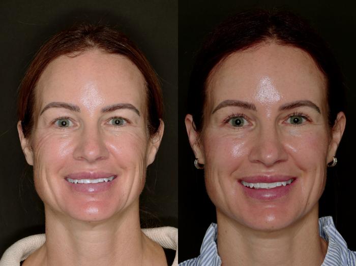 Before & After Blepharoplasty Case 774 Back View in Fort Worth & Arlington, Texas