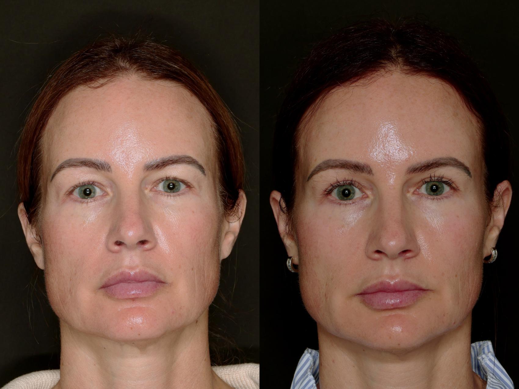 Before & After Blepharoplasty Case 774 Front View in Fort Worth & Arlington, Texas