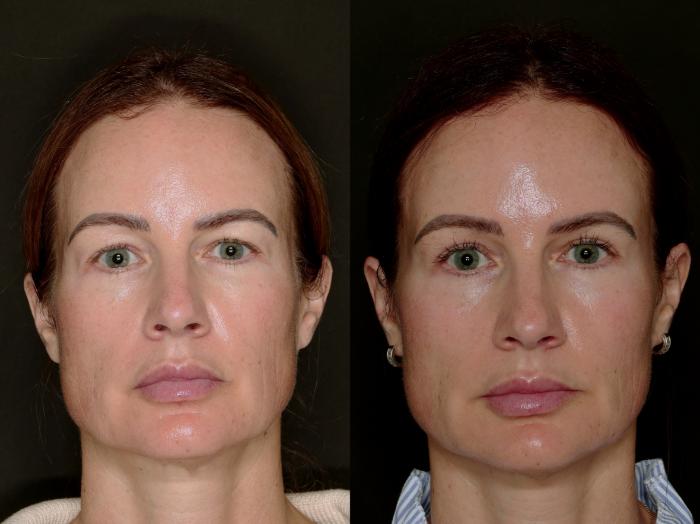 Before & After Blepharoplasty Case 774 Front View in Fort Worth & Arlington, Texas