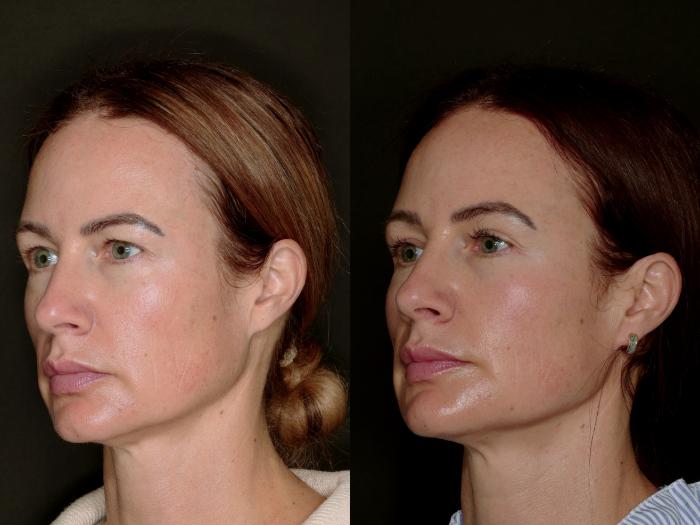 Before & After Blepharoplasty Case 774 Left Oblique View in Fort Worth & Arlington, Texas