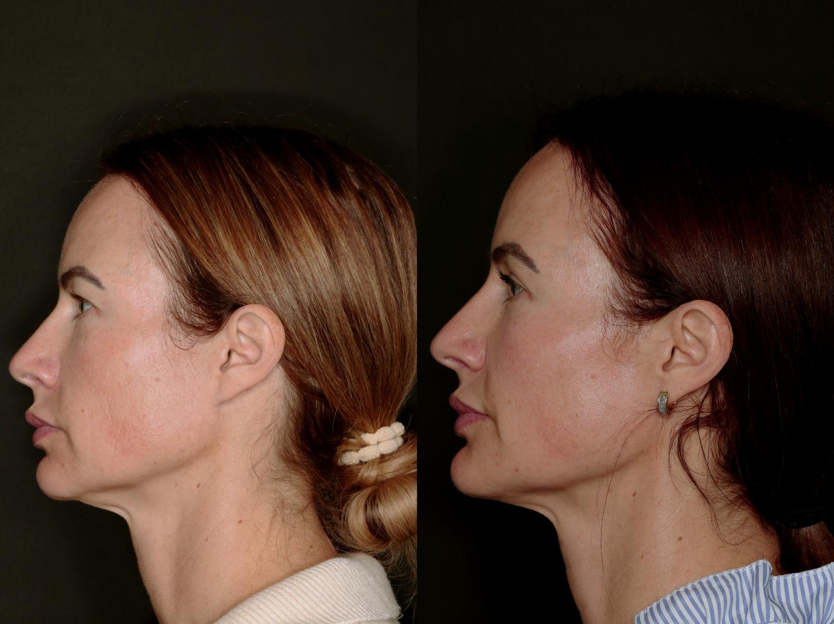 Before & After Blepharoplasty Case 774 Left Side View in Fort Worth & Arlington, Texas