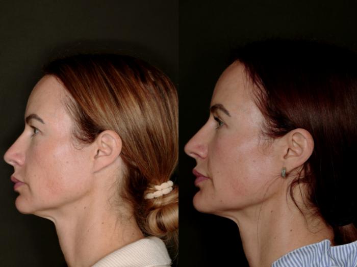 Before & After Blepharoplasty Case 774 Left Side View in Fort Worth & Arlington, Texas