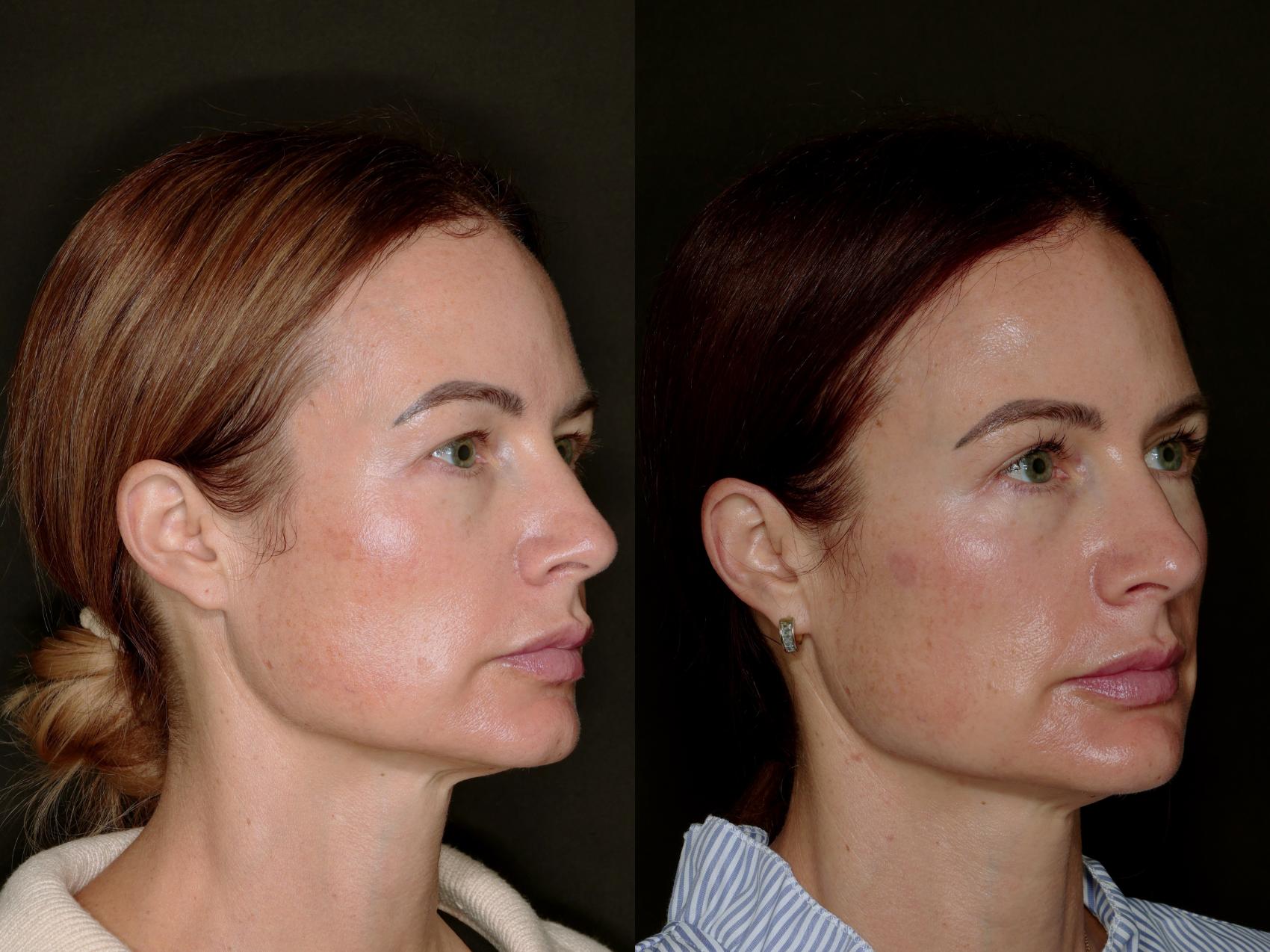 Before & After Blepharoplasty Case 774 Right Oblique View in Fort Worth & Arlington, Texas