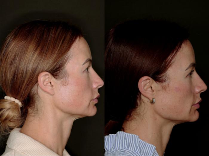 Before & After Blepharoplasty Case 774 Right Side View in Fort Worth & Arlington, Texas