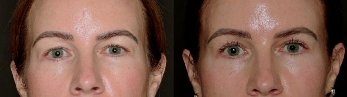 Before & After Blepharoplasty Case 779 Front View in Fort Worth & Arlington, Texas