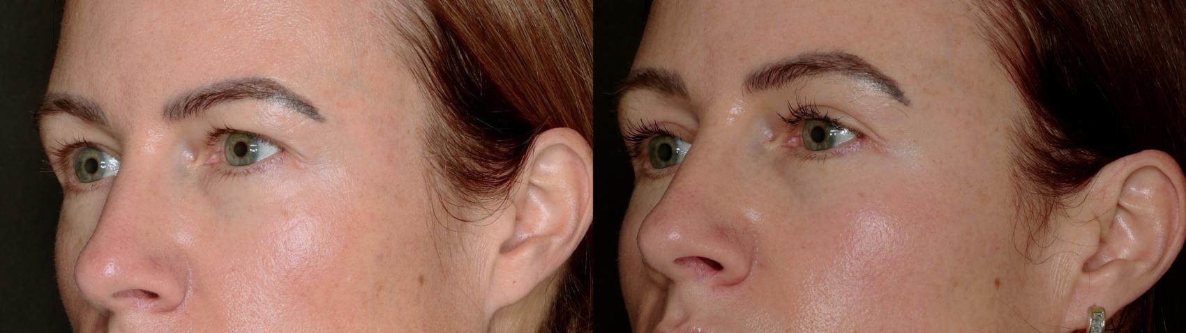 Before & After Blepharoplasty Case 779 Left Oblique View in Fort Worth & Arlington, Texas
