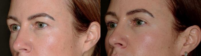 Before & After Blepharoplasty Case 779 Left Oblique View in Fort Worth & Arlington, Texas