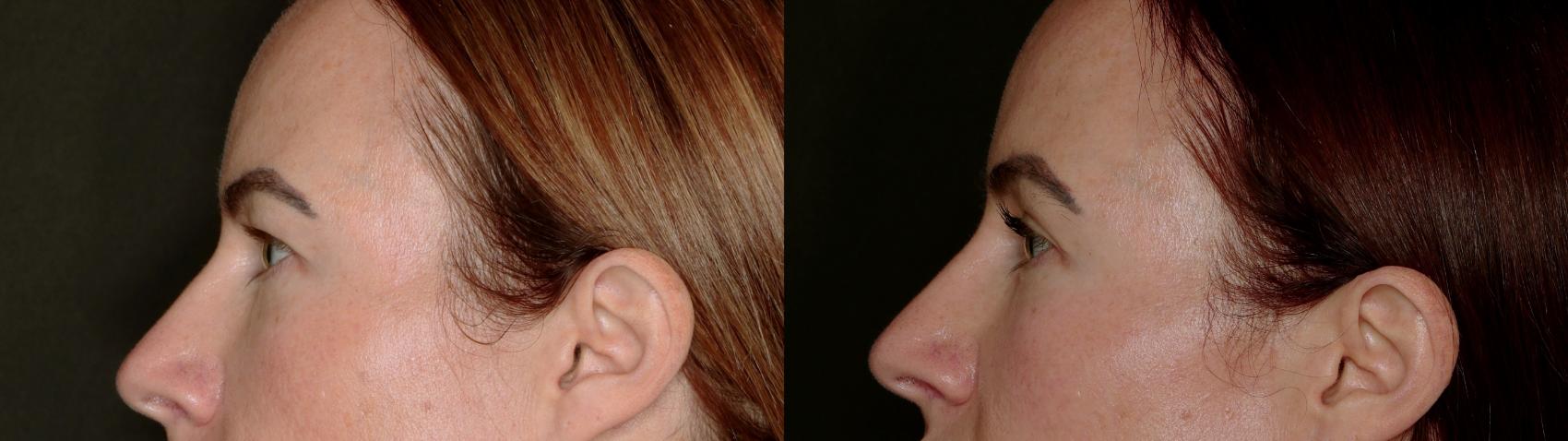 Before & After Blepharoplasty Case 779 Left Side View in Fort Worth & Arlington, Texas