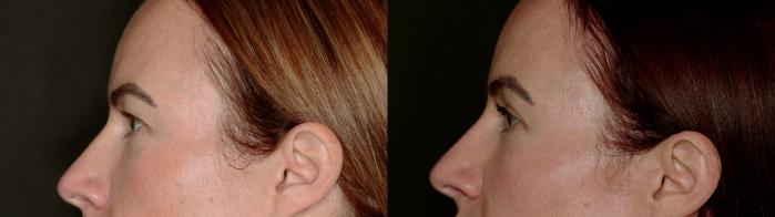 Before & After Blepharoplasty Case 779 Left Side View in Fort Worth & Arlington, Texas
