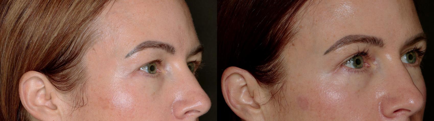 Before & After Blepharoplasty Case 779 Right Oblique View in Fort Worth & Arlington, Texas