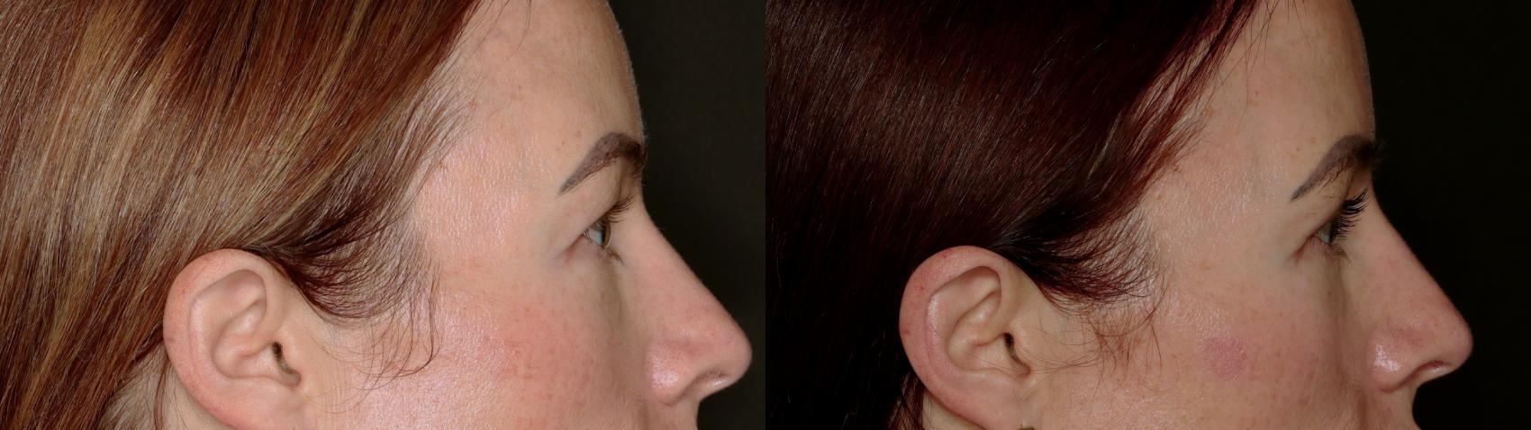 Before & After Blepharoplasty Case 779 Right Side View in Fort Worth & Arlington, Texas