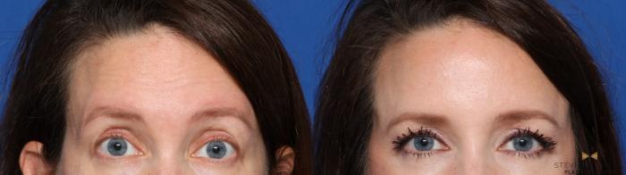 Before & After BOTOX Case 484 Front View in Fort Worth & Arlington, Texas