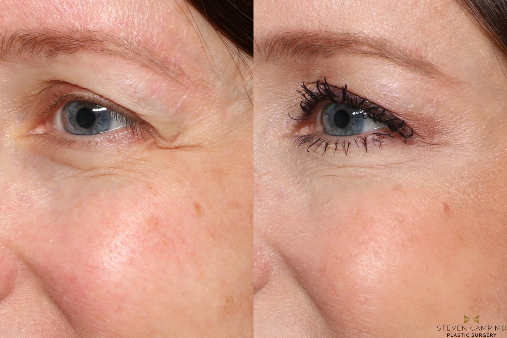 Before & After BOTOX Case 484 Left Oblique View in Fort Worth, Texas