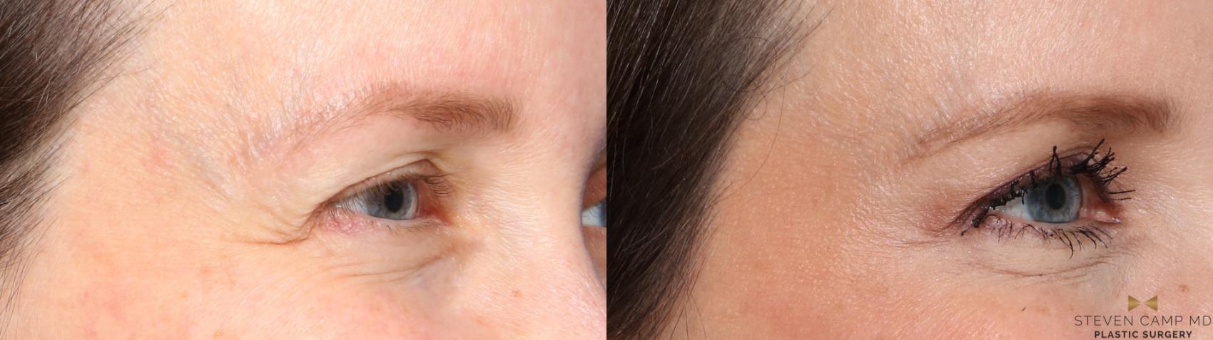 Before & After BOTOX Case 484 Right Oblique View in Fort Worth, Texas