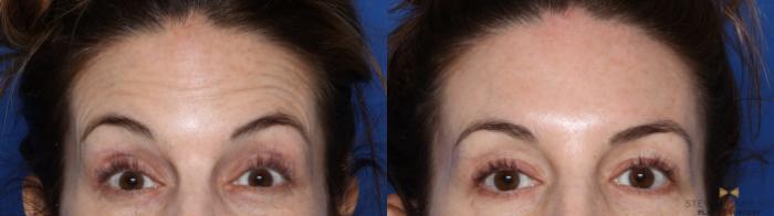 Before & After BOTOX Case 485 Front View in Fort Worth, Texas