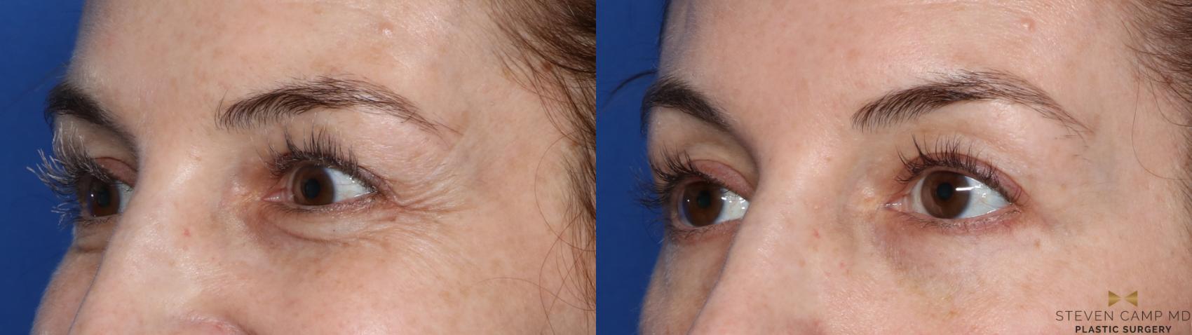 Before & After BOTOX Case 485 Left Oblique View in Fort Worth, Texas